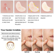 Hydrocolloid Acne Patch(20 Patches), Large Spot Control Cover With Long Size, Extra Larger Acne Pimple Patch for Covering Large Breakouts, Spot Patch, Stickers for Body, Cheek, Forehead, and Chin