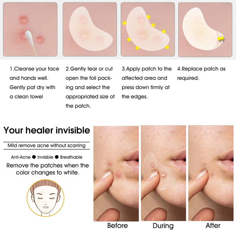 Hydrocolloid Acne Patch(20 Patches), Large Spot Control Cover With Long Size, Extra Larger Acne Pimple Patch for Covering Large Breakouts, Spot Patch, Stickers for Body, Cheek, Forehead, and Chin