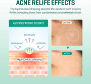 SOME BY MI 30 Days Miracle Clear Spot Patch - Pack of 5, 90 Counts, 2 Size(10mm 45Counts, 12mm 45Counts) - Invisible Hydrocolloid Skin Trouble and Pimple Patch with No Irritation - Korean Skin Care