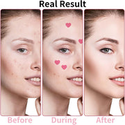 Heart-Shaped Pimple Patches for Acne Treatment, Love Heart Acne Spot Patches Pimple Solution Pink Love Heart Patches Spot Patches with Niacinamide and Hyaluronic Acid for Moisturizing, Blemish Spot