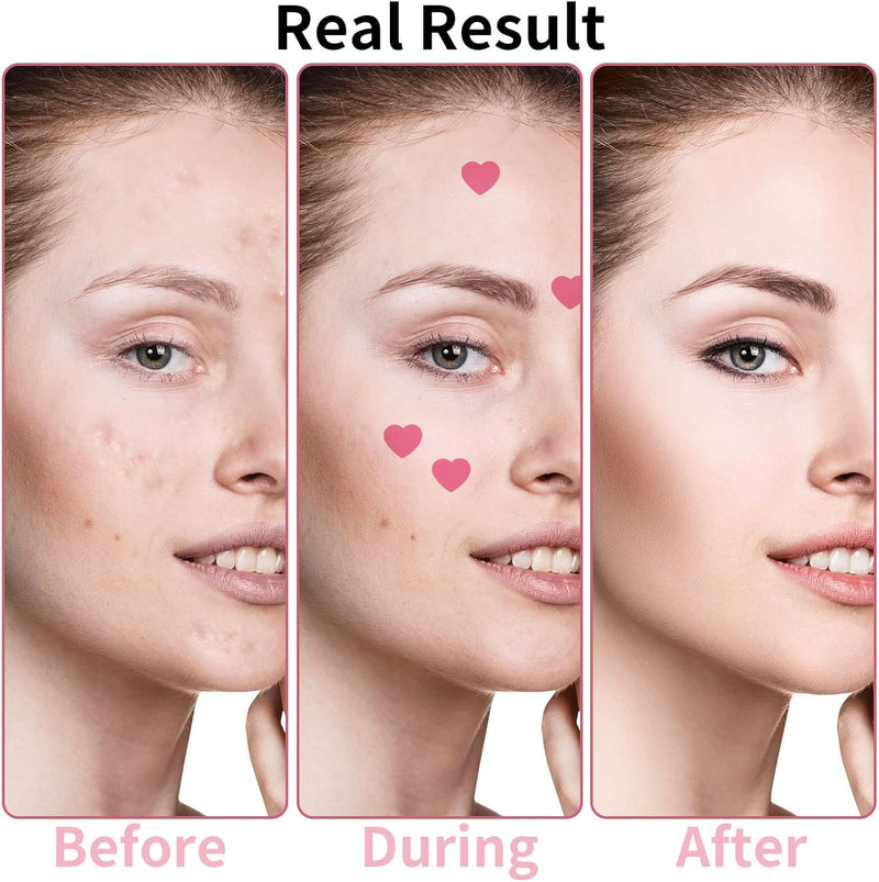 Heart-Shaped Pimple Patches for Acne Treatment, Love Heart Acne Spot Patches Pimple Solution Pink Love Heart Patches Spot Patches with Niacinamide and Hyaluronic Acid for Moisturizing, Blemish Spot