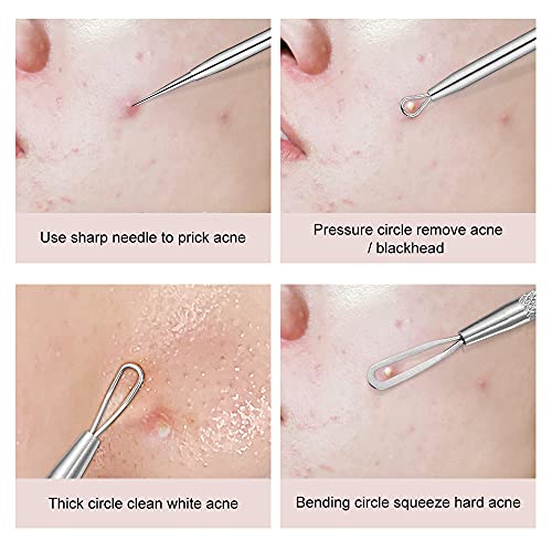 La Chat Blackhead Remover, 2 PCS Pimple Popper ,Stainless Steel Pimple Extractor Blackhead Removal Tool Risk Free Treatment for Blemish,Whitehead Popping