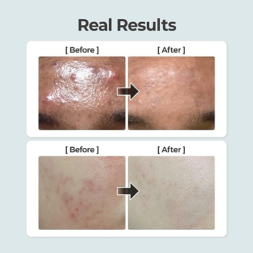 numbuzin No.1 Toner | Pure-Full Calming Herb Toner | Breakouts, Redness, Excess Oil Control, Blackhead Removal | Centella Asiatica, Heartleaf, Licorice Root | Acne-Prone, Sensitive Skin | 300ml