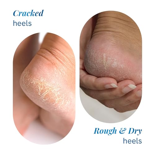 Be Bodywise 20% Urea Foot Cream Roll On | Repairs Dry & Cracked Heels | 2% Lactic Acid, Olive Oil & Vitamin E I Exfoliates & Softens Skin I Hydrates & Moisturises INo Irritation IAll Skin TypesI 50 ml