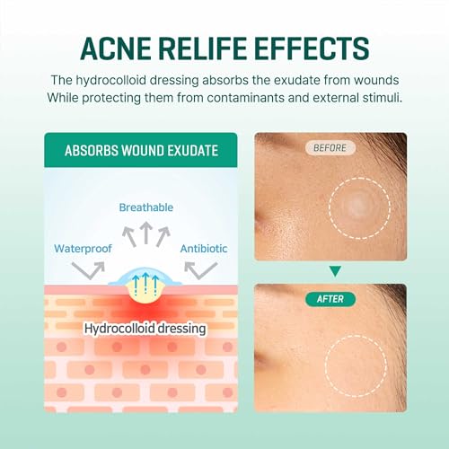 Some By Mi 30 Days Miracle Clear Spot Patch | 18 Counts, 2 Size(10mm 9Counts, 12mm 9Counts) | Invisible Hydrocolloid Skin Trouble & Pimple Patch with No Irritation | Pack of 1
