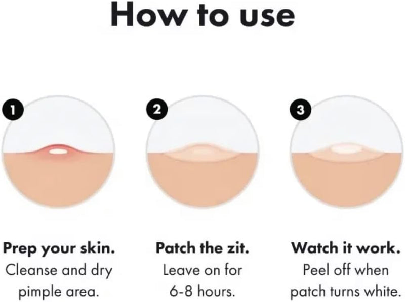 Genuine Acne Spot Treatment Patch and Pimple Treatment Patch