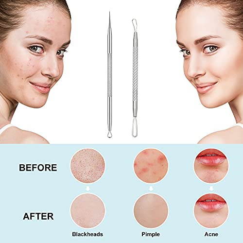 La Chat Blackhead Remover, 2 PCS Pimple Popper ,Stainless Steel Pimple Extractor Blackhead Removal Tool Risk Free Treatment for Blemish,Whitehead Popping