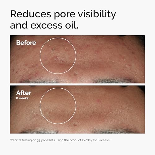 The Ordinary Niacinamide 10% + Zinc 1% - 30 ml, 769915190311