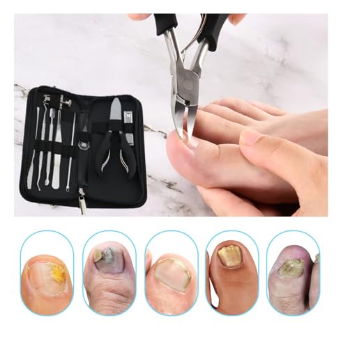 MAKINGTEC 10Pcs/Set Ingrown Toenail Tools Kit, Nail Treatment Foot Tool,Ingrown Toenail Removal Correction Clippers, Surgery Grade Nail File Lifter, Professional Pedicure Tool whit Storage Package