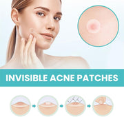TERRIFI Pimple Patches for Face, 300 Hydrocolloid Patches, Effectively Cover and Repair Acne and Blemishes, Promote Skin Regeneration, Ideal for Makeup and Skincare