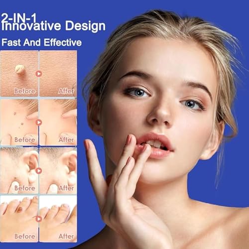 ALMEKAQUZ Home Wart Removal Tool Set for Face and Body,Professional blackhead and acne tool for women and men, Quick and painless blemish cleansing with easy to grip handles, Skincare accessory tha
