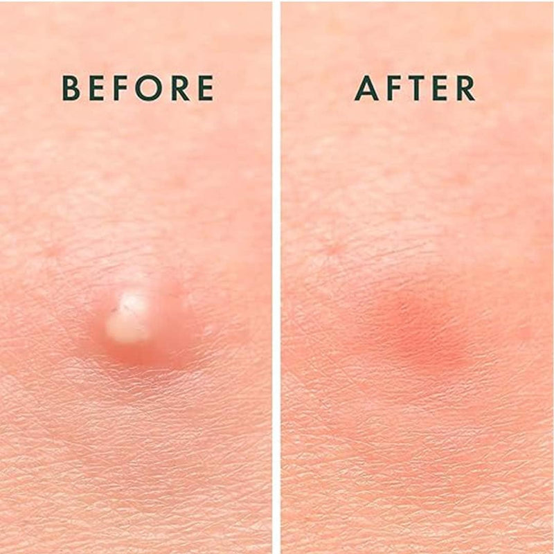 ABC Acne Pimple Patch for Face (108 dots) | Waterproof Patches for Active Acne | Absorbs Pimple Overnight and Reduces Excess Oil | Facial Patches with 100% Hydrocolloid
