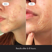 Mighty Patch Surface - Hydrocolloid Large Acne Pimple Patch Spot Treatment (10 count) for Body and Larger Breakouts on Cheek, Forehead, Chin, Vegan, Cruelty-Free, 50% Better Absorption