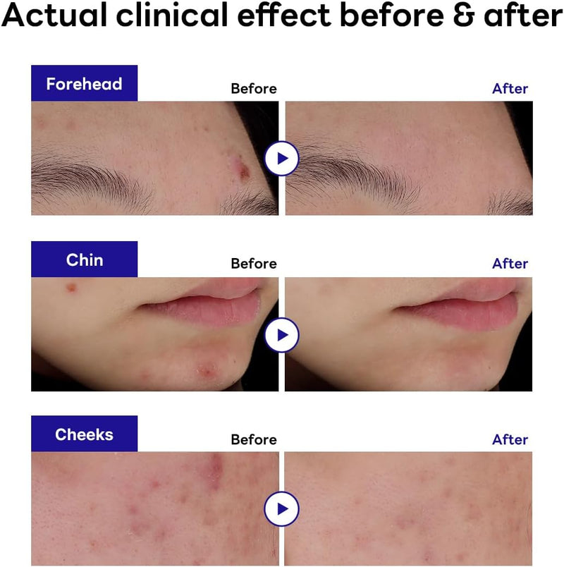 MEDIHEAL Derma Clear Madecassoside Blemish Patch (44 Counts) - Acne Spot Protection, Fast Healing with Madecassoside & Niacinamide