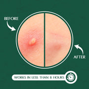 Aroura Premium | Deep Blemish Microdart Patches | Target Early-Stage & Deep Pimples | Infused with Salicylic Acid, Tea Tree Oil, Niacinamide, Cica & Hyaluronic Acid | 9 Precision acne Patches