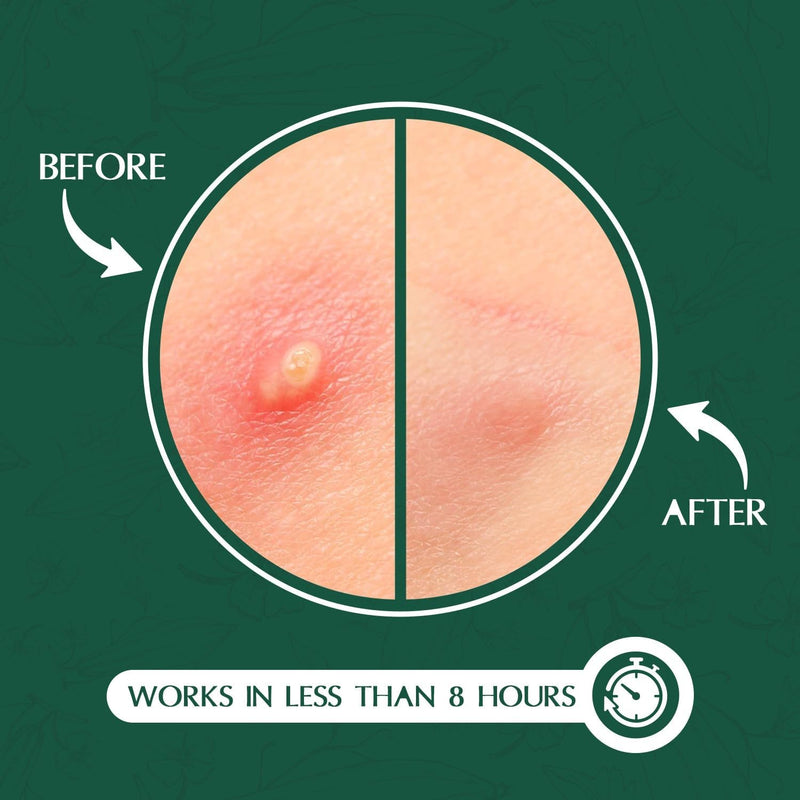 Aroura Premium | Deep Blemish Microdart Patches | Target Early-Stage & Deep Pimples | Infused with Salicylic Acid, Tea Tree Oil, Niacinamide, Cica & Hyaluronic Acid | 9 Precision acne Patches