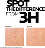 La Roche Posay Effaclar Duo+M 3H Spot Patches for Acne Prone Skin