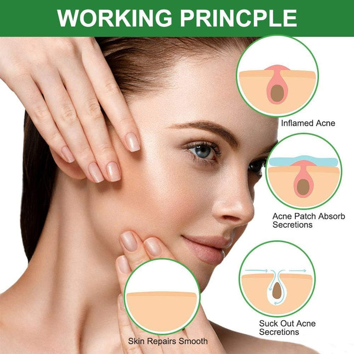 Azonee 24 Pcs Translucent Generic Acne Patches, Hydrocolloid Acne Patches Zit Patches for Face Acne Spot Treatment, Fast-Acting Hydrocolloid. Waterproof, Vegan, Perfect Spot Treatment Stickers.