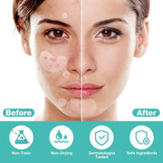 BUTBU 265 Pieces Pimple Pimple Pimple Patches Invisible Pimple Pimple Pimple Patches 2-in-1 with Tea Tree Oil Salicylic Acid Day and Night Waterproof and Breathable Get Rid of Acne Fast