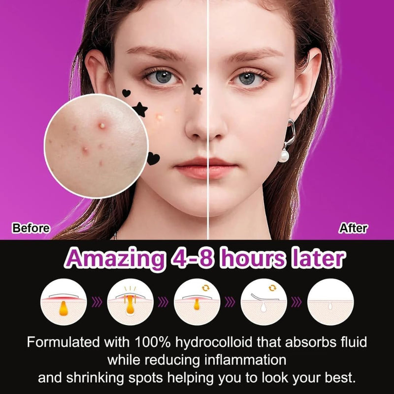 NIKITA.VIVI - 144 Pcs Acne Pimple Patch Star + Heart Shape | Acne Patch Treatment with Hydrocolloid & Tea Tree Oil | Star Face Pimple Patches | Spot Cover Stickers| Acne Healing Miracle Patches