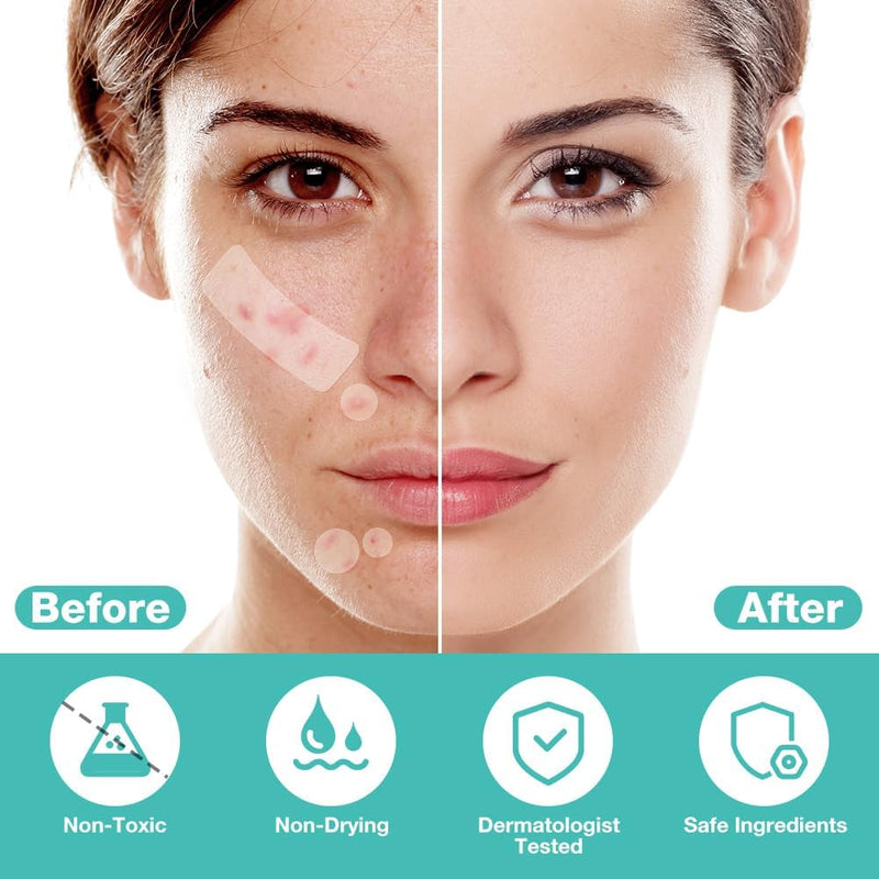 BUTBU 265 Pieces Pimple Pimple Pimple Patches Invisible Pimple Pimple Pimple Patches 2-in-1 with Tea Tree Oil Salicylic Acid Day and Night Waterproof and Breathable Get Rid of Acne Fast