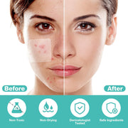BUTBU 265 Pieces Pimple Pimple Pimple Patches Invisible Pimple Pimple Pimple Patches 2-in-1 with Tea Tree Oil Salicylic Acid Day and Night Waterproof and Breathable Get Rid of Acne Fast
