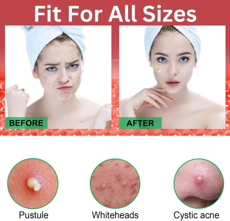 NIKITA.VIVI - 144 Pcs Acne Pimple Patch Star + Heart Shape | Acne Patch Treatment with Hydrocolloid & Tea Tree Oil | Star Face Pimple Patches | Spot Cover Stickers| Acne Healing Miracle Patches