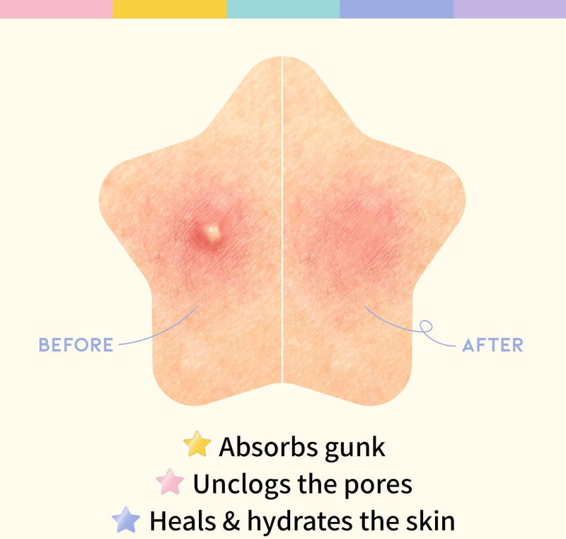 OOTD Star-shaped Hydrocolloid Acne/Pimple patch with 5 Pastel Color/Niacinamide & Ceramide Formula: Hydrocolloid Pimple Patches, Ideal for Blemish Spots (80 Count)