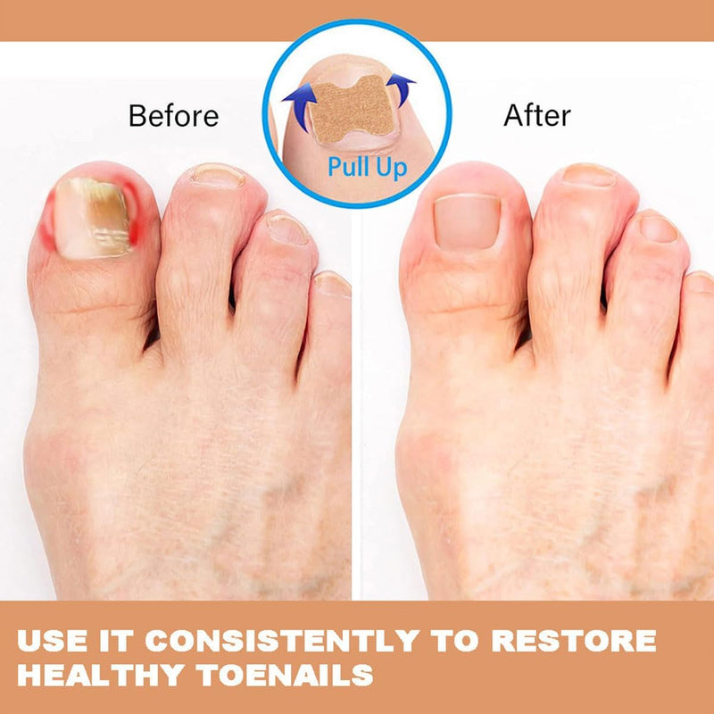 Multi-Purpose Nail Repair Patches 50Pcs, Nail Repair Toenail Treatment for Nail Fungus Damage, 8-Hour Treatment Restores Healthy Appearance