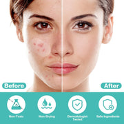 BUTBU 265 Pieces Pimple Pimple Pimple Patches Invisible Pimple Pimple Pimple Patches 2-in-1 with Tea Tree Oil Salicylic Acid Day and Night Waterproof and Breathable Get Rid of Acne Fast