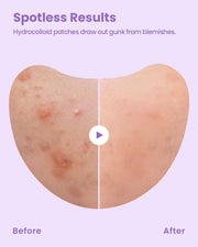 GLAM UP Spotless Wide Patch Hydrocolloid Coverage for Face Pores, Zits, and Oil - Strong Gunk Absorption Overnight, and Calm Treatment with Tea Tree (12 Patches)
