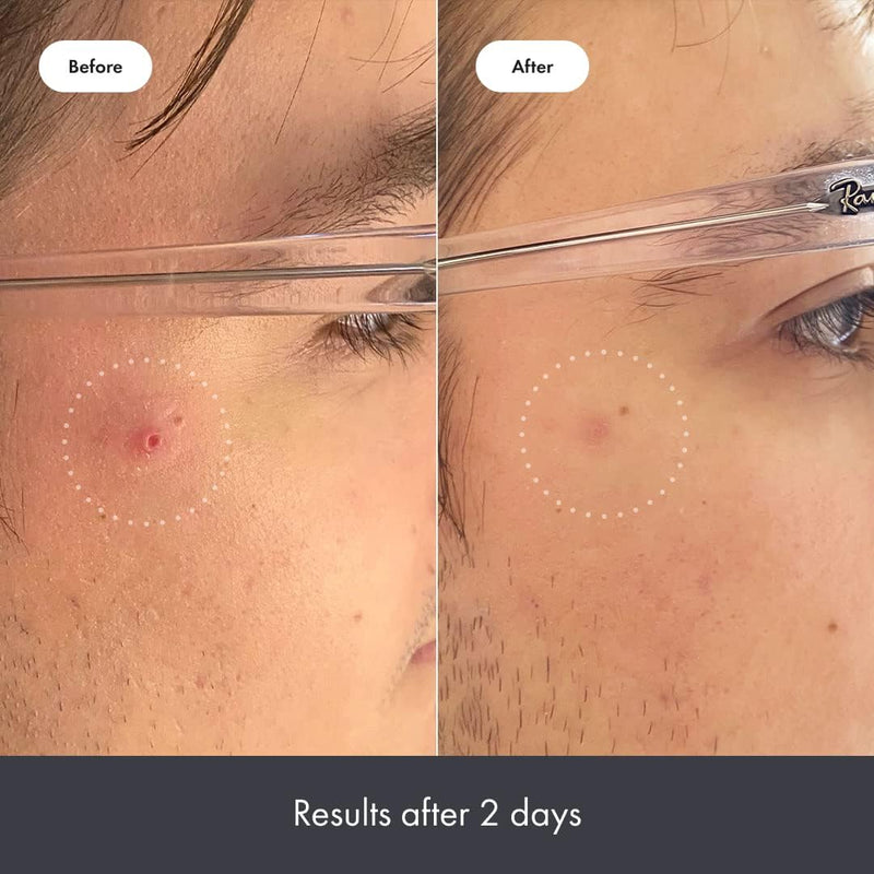 Mighty Patch Rescue Balm Post-Blemish Recovery Cream from Hero Cosmetics - Intensive Nourishing and Calming for Dry, Red-Looking Skin After a Blemish - Dermatologist Tested (50 ml)