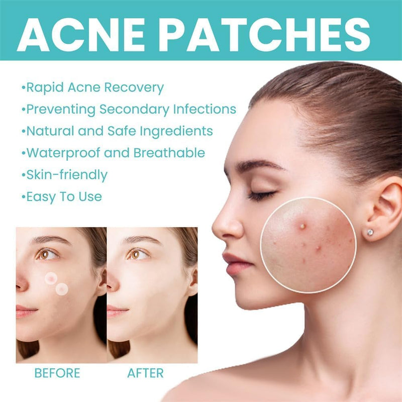 TERRIFI Pimple Patches for Face, 300 Hydrocolloid Patches, Effectively Cover and Repair Acne and Blemishes, Promote Skin Regeneration, Ideal for Makeup and Skincare