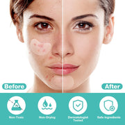 BUTBU 265 Pieces Pimple Pimple Pimple Patches Invisible Pimple Pimple Pimple Patches 2-in-1 with Tea Tree Oil Salicylic Acid Day and Night Waterproof and Breathable Get Rid of Acne Fast
