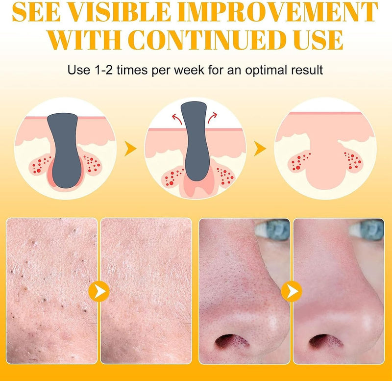 Arabest Nose Strips, 10 Count Nose Patch, Hydrocolloid Patches Nose with Instant Blackhead Removal and Pore Unclogging, Blackhead Patches Nose for Pimples, Zits and Oil