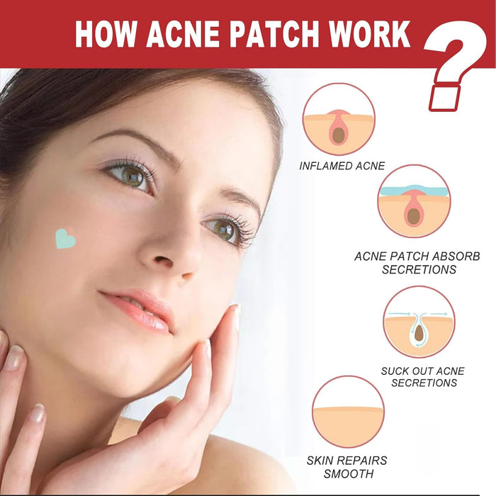 NALACAL Hydrocolloid Pimple Patches – Anti-Acne, Waterproof and Moisturizing Patches for Fast Healing and Blemish Protection