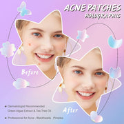KANZA - 30 Pcs T-Zone Hydrocolloid Patches| Cleansing Blackhead Remover| Acne Patch Pimple Remover for Zit Breakouts |Nose and Forehead Patch |Painless,Safe |Removes Pimple,Acne Nose Gunk Pores