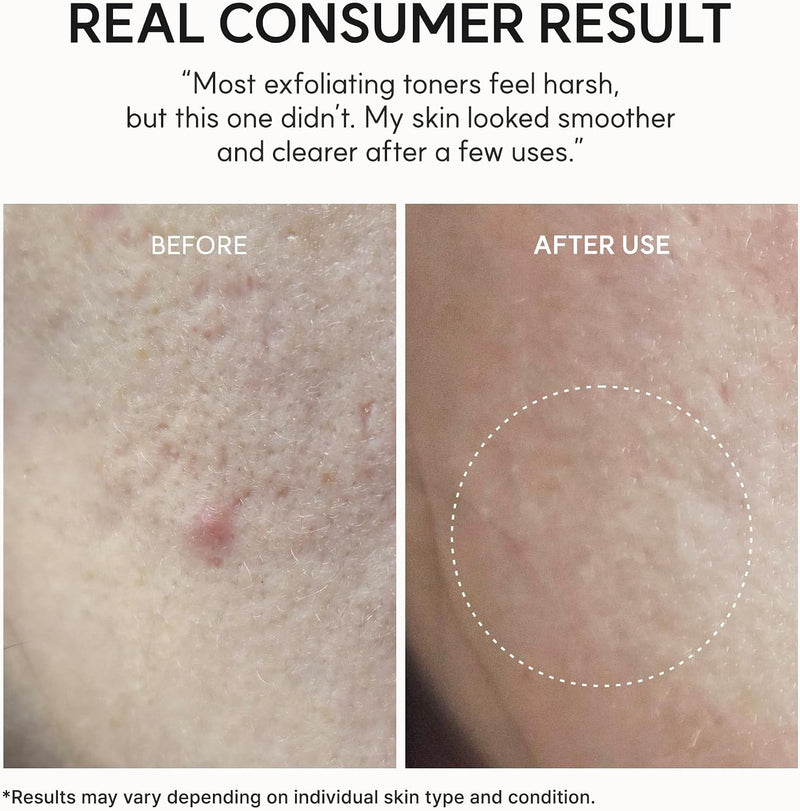 Erasor Glycolic Acid 10% Exfoliating Toner, AHA + BHA Liquid Exfoliant for Skin Texture & Pore Care, Hydrating & Smoothing Formula, 200ml / 6.76 fl oz