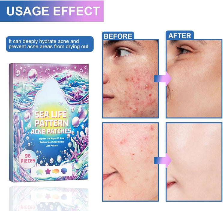 Azonee Pimple Patches for Face, Hydrocolloid Acne Patches Cute Star Zit Covers Spot Cover Stickers 180 Pcs with Tea Tree Salicylic Acid Natural Green Algae Extract Blemish Spot Stickers, 5 Styles