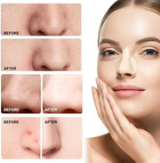 Nose Pore Strips, Hydrocolloid Patches for Pores and Pimples, Blackhead Remover for Overnight, Nose and Face Clean (12 count)