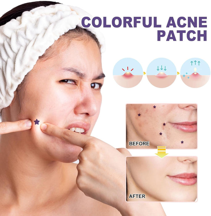 Azonee Pimple Patches for Face, Hydrocolloid Acne Patches Cute Star Zit Covers Spot Cover Stickers 180 Pcs with Tea Tree Salicylic Acid Natural Green Algae Extract Blemish Spot Stickers, 5 Styles