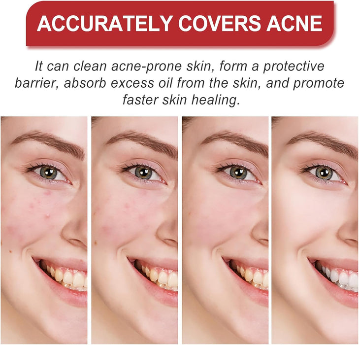 NALACAL Hydrocolloid Pimple Patches – Anti-Acne, Waterproof and Moisturizing Patches for Fast Healing and Blemish Protection