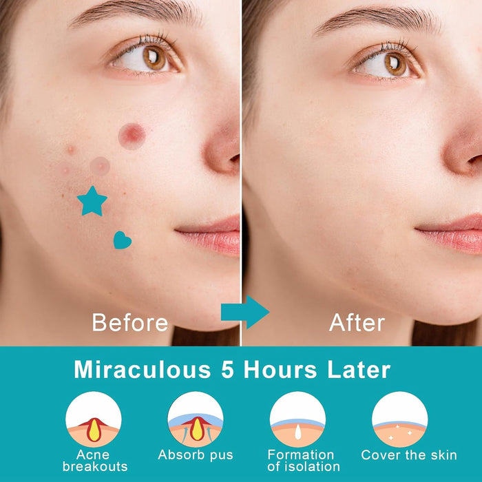 NALACAL Hydrocolloid Acne Healing Patches – 288 Waterproof Pimple Patches for Blemish Care, Anti-Acne Spot Treatment with Moisturizing Protection to Speed Up Skin Recovery and Promote Clear Skin