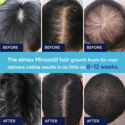 5% Minoxidil Foam for Men and Women, Hair Growth Suitable for Hair Thinning Receding Hairline, Hair Loss to Hair Regrowth Get Thicker Fuller Hair