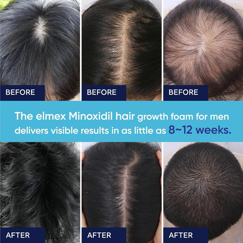 5% Minoxidil Foam for Men and Women, Hair Growth Suitable for Hair Thinning Receding Hairline, Hair Loss to Hair Regrowth Get Thicker Fuller Hair