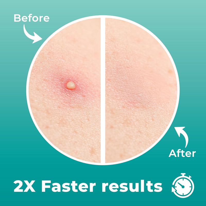 PatchRx Pimple Patches for Nose (12 Pack), Treat Nose Pimples Overnight - Hydrocolloid Acne Patches - Pimple Patch Hydrocolloid Patches &Pimple Stickers, Nose Strip, Zit Patches - Nose Pimple Patches
