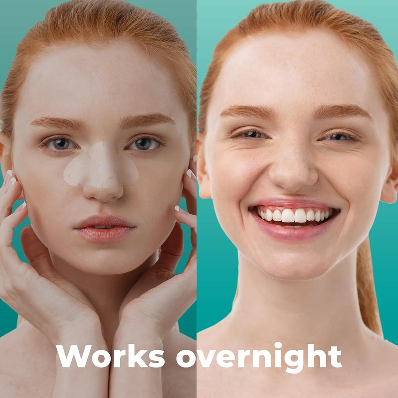 PatchRx Pimple Patches for Nose (12 Pack), Treat Nose Pimples Overnight - Hydrocolloid Acne Patches - Pimple Patch Hydrocolloid Patches &Pimple Stickers, Nose Strip, Zit Patches - Nose Pimple Patches