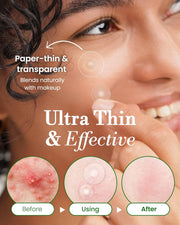 Troubless Invisible Pimple Patch Classic, 96 Patches (2 Sizes) – Ultra Thin Hydrocolloid Spot Treatment for Daytime Use, Easy Peel, Fast Healing, Absorbs Oil & Impurities, For Acne-Prone Skin