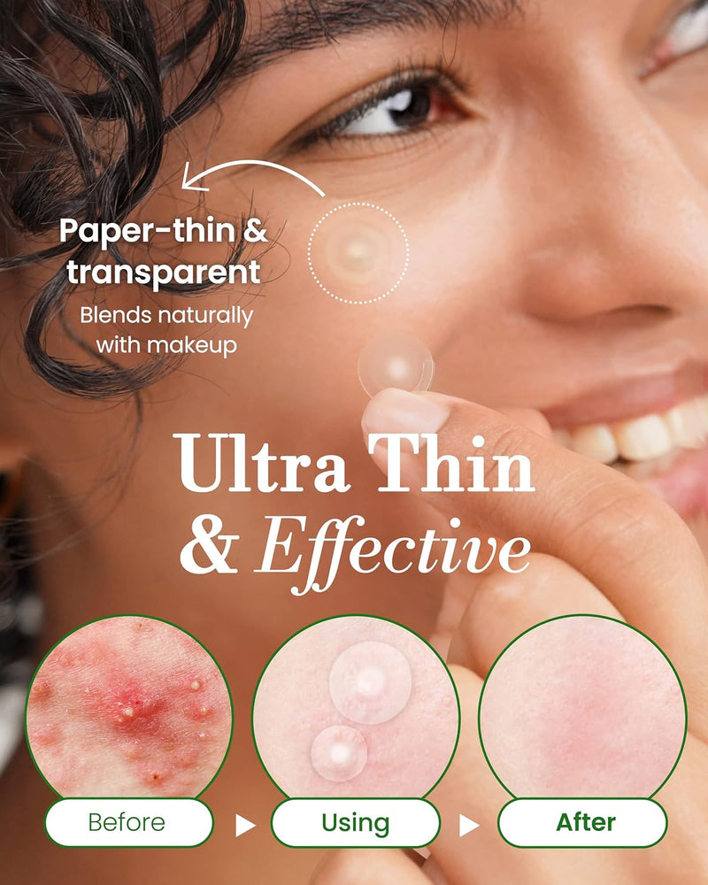 Troubless Invisible Pimple Patch Classic, 96 Patches (2 Sizes) – Ultra Thin Hydrocolloid Spot Treatment for Daytime Use, Easy Peel, Fast Healing, Absorbs Oil & Impurities, For Acne-Prone Skin