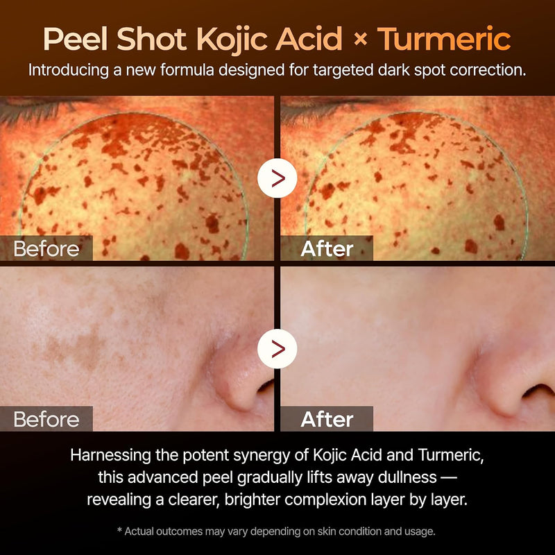 Peel Shot Kojic Acid Turmeric Serum Exfoliating Dark Spot Corrector With Aha/Bha & Niacinamide, Brightening & Even Complexion Facial Serum 2.71 Fl Oz (Pack of 1)